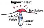 Ingrown Hair Diagram